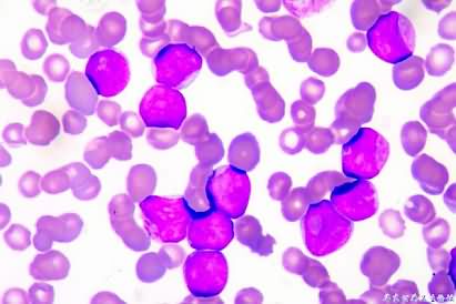 New-treatment-approved-for-deadly-blood-cancer