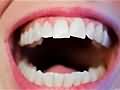 研究显示牙周病可能是阿尔茨海默病促成因素《合众国际社》
