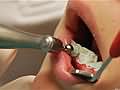 研究表明，大多数牙医开的抗生素是不必要的