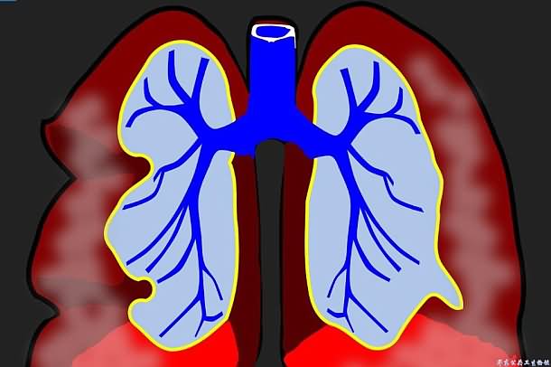 肺癌与放射治疗
