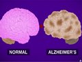 早期结果显示，实验性阿尔茨海默病药物可以减缓患者认知能力的下降